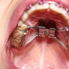 Metalowy aparat ortodontyczny z brokatem, rozszerzający szczękę. Taki guzik ortodontyczny do czego służy? Do poszerzenia łuku zębowego.