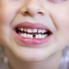 Uśmiechnięta buzia dwulatka z widocznym zgryzem otwartym. Brakuje dwóch przednich zębów.