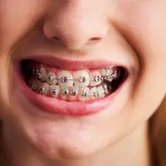 Uśmiechnięta twarz z aparatem ortodontycznym. Krótka wizyta u dentysty, a potem już tylko czekanie na efekt. Ile trwa zakładanie aparatu?