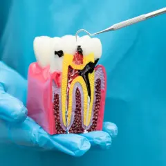 Model zęba z widocznym wypełnieniem kanałów korzeniowych gutaperką. Dentysta pokazuje, jak wygląda prawidłowe leczenie kanałowe.