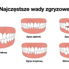Zgryz krzyżowy to jedna z wad zgryzowych, gdzie zęby górne zachodzą na dolne w nieprawidłowy sposób.