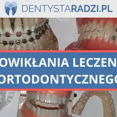Modele szczęk z aparatami ortodontycznymi i nakładkami. Temat: powikłania leczenia ortodontycznego, w tym ból zębów po zdjęciu aparatu.