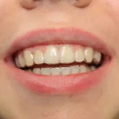 Uśmiech z aparatem Invisalign. Widoczne przezroczyste nakładki na zębach, które korygują zgryz. Efekty leczenia są już widoczne.