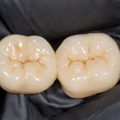 Dwa połączone zęby ceramiczne z widocznymi bruzdami na zębach, gotowe do odbudowy uśmiechu.