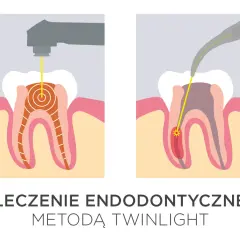 Ilustracja pokazuje laserowe leczenie zębów. Dwa schematy przedstawiają zastosowanie lasera w leczeniu kanałowym, podkreślając jego precyzję i skuteczność.