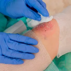 Lekarz w niebieskich rękawiczkach delikatnie oczyszcza ranę, na której widoczny jest biofilm.