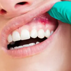 Gingivitis, zapalenie dziąseł. Periodontolog czym się zajmuje? Leczeniem chorób przyzębia, w tym zapalenia dziąseł.