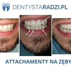 Przed i po: czy nakładki na zęby działają? Widoczne zbliżenie na uśmiech mężczyzny z widocznymi nierównościami, a następnie z nałożonymi przezroczystymi nakładkami.
