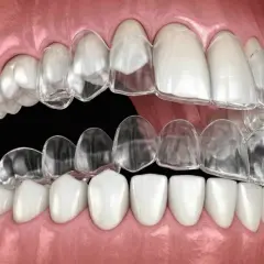 Przezroczyste nakładki na zęby, czyli Invisalign, to nowoczesna metoda korekty zgryzu. Widoczne są kolejne etapy leczenia.
