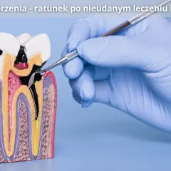 Model zęba z widocznym uszkodzeniem po leczeniu kanałowym. Dłoń w rękawiczce stomatologicznej wykonuje zabieg resekcji korzenia.