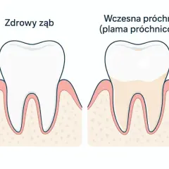 Porównanie zdrowego zęba z zębem z wczesną próchnicą. Widać, że próchnica tworzy na zębie nieestetyczną plamę, która może przerodzić się w dziurę.