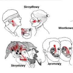 Ilustracje pokazują punkty bólu związane z zapaleniem stawu skroniowo-żuchwowego.