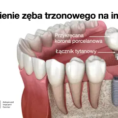 Budowa zęba trzonowego na implancie: implant tytanowy, łącznik i korona porcelanowa.