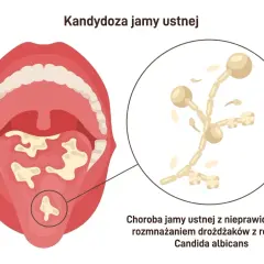 Ilustracja przedstawia jamę ustną z białymi nalotami na języku i podniebieniu, wskazującymi na nieleczona grzybica jamy ustnej. Obok powiększony obraz drożdżaków Candida albicans.