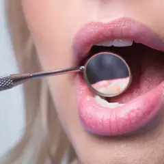 Usta kobiety z otwartymi zębami, w których odbija się lusterko dentystyczne. Widoczny brak szkliwa na zębach.