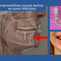 Rentgen żuchwy z nieprawidłową pozycją na szynie zgryzowej. Widoczna szyna i uśmiech pacjentki.