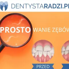 Proste wyrównanie zębów dzięki aparatowi ortodontycznemu. Przed i po leczeniu.