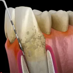 Model zęba z widocznymi oznakami chorób przyzębia. Narzędzie dentystyczne bada kieszonkę dziąsłową, ujawniając problemy, które mogą wskazywać na rzadkie choroby zębów.