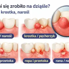Guzek, krostka, narośl na dziąśle. Ilustracje pokazują różne zmiany, w tym ropień, przetokę i ranę, które mogą być objawem ziarniny w zębie.