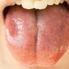 Język z widocznymi grudkami, być może jako skutki uboczne elugel.