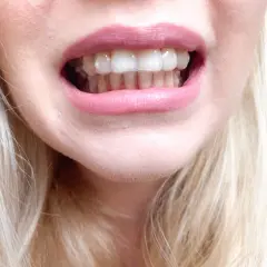 Uśmiech z widocznymi, przezroczystymi nakładkami Invisalign na zębach.
