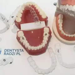 Modele szczęk z przezroczystymi nakładkami, które są częścią aparatu u dentysty.