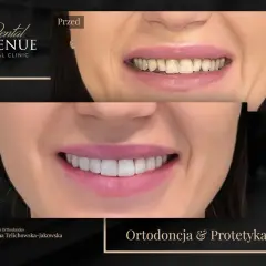 Uśmiech przed i po leczeniu ortodontycznym. Piękne, proste zęby po metamorfozie.