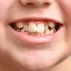 Uśmiech dziecka z widocznymi krzywymi zębami. Zęby są lekko nierówne, niektóre zachodzą na siebie, co jest typowe dla krzywych zębów u dzieci.