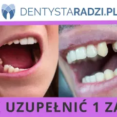 Ubytek w uzębieniu, widoczna budowa zęba jedynki po utracie.