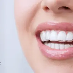 Uśmiechnięta kobieta z dyskretnymi, przezroczystymi nakładkami na zęby. Inter Dental Turkey oferuje estetyczne rozwiązania dla pięknego uśmiechu.