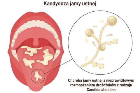 Ilustracja przedstawia jamę ustną z białymi nalotami na języku i podniebieniu, wskazującymi na nieleczona grzybica jamy ustnej. Obok powiększony obraz drożdżaków Candida albicans.