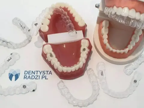 Przezroczyste nakładki ortodontyczne - Czy warto? Pełny przewodnik