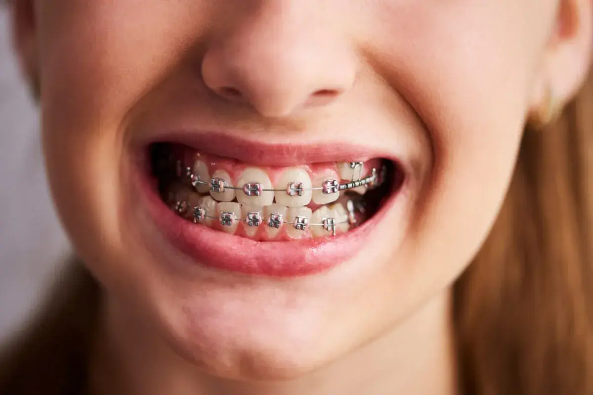 Uśmiechnięta twarz z aparatem ortodontycznym. Krótka wizyta u dentysty, a potem już tylko czekanie na efekt. Ile trwa zakładanie aparatu?