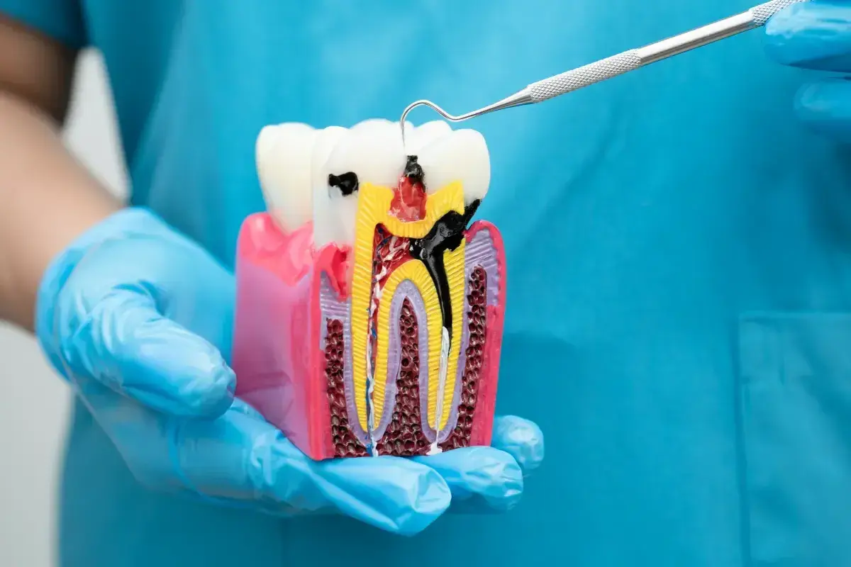 Model zęba z widocznym wypełnieniem kanałów korzeniowych gutaperką. Dentysta pokazuje, jak wygląda prawidłowe leczenie kanałowe.