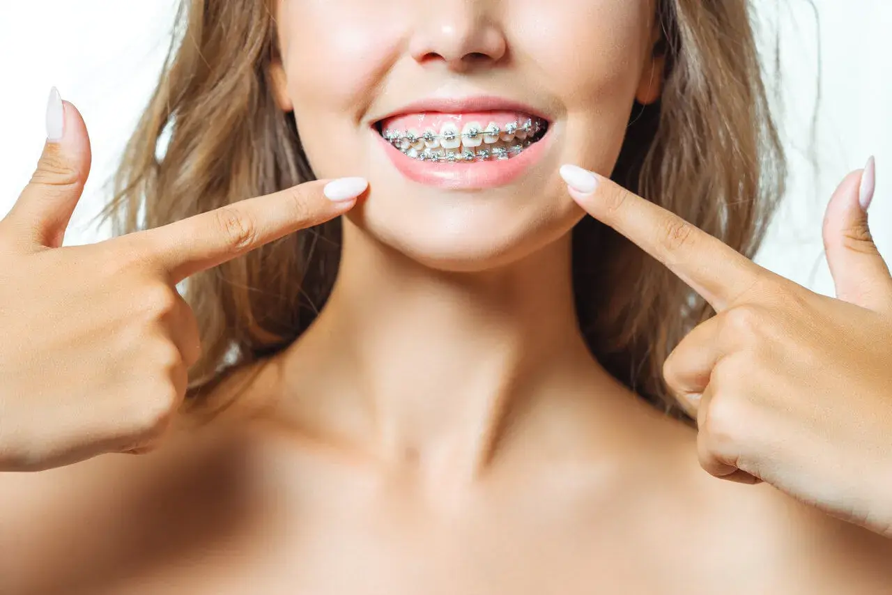 Uśmiechnięta kobieta pokazuje swoje zęby z metalowymi wyciągami ortodontycznymi. Dłonie z paznokciami wskazują na aparat.