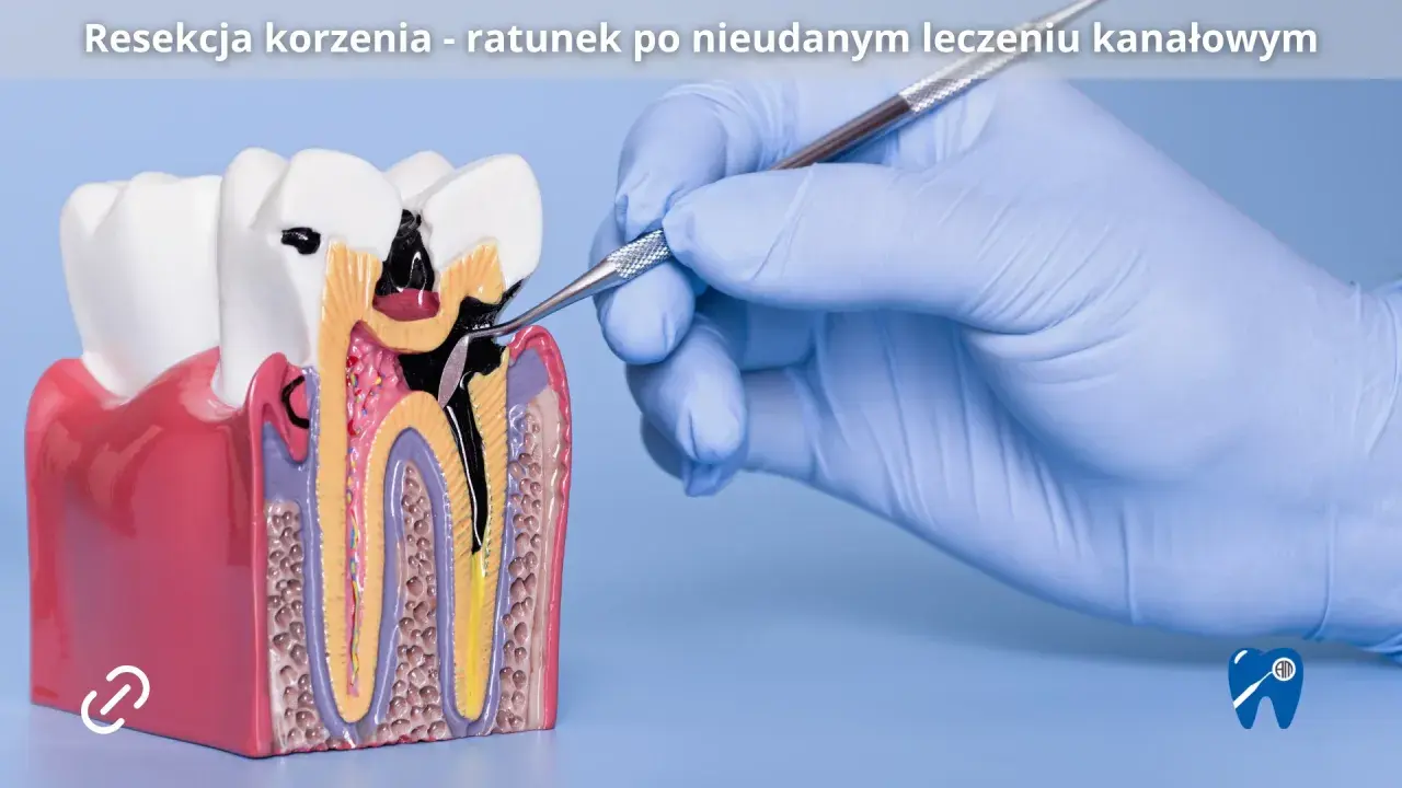 Model zęba z widocznym uszkodzeniem po leczeniu kanałowym. Dłoń w rękawiczce stomatologicznej wykonuje zabieg resekcji korzenia.
