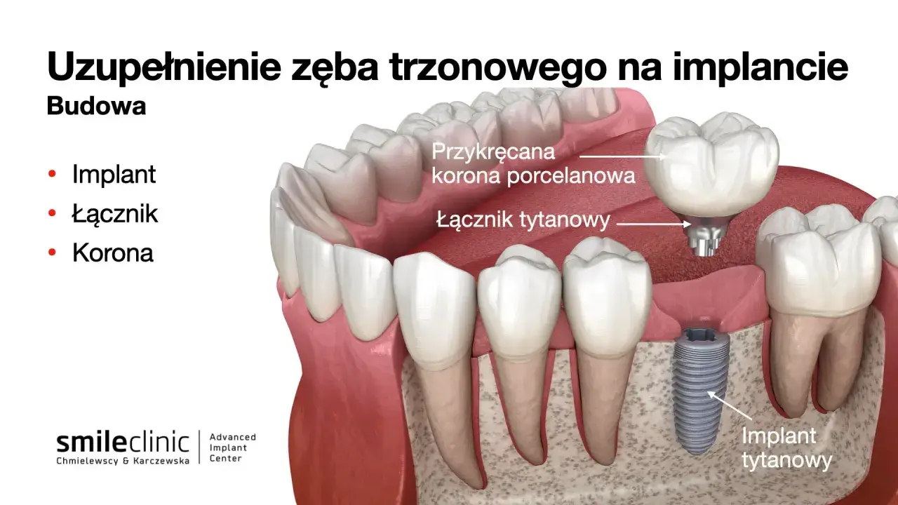 Budowa zęba trzonowego na implancie: implant tytanowy, łącznik i korona porcelanowa.