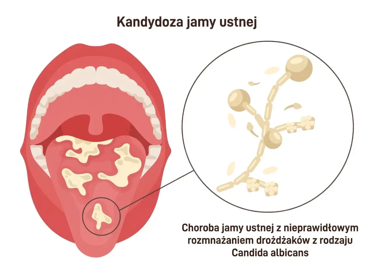 Ilustracja przedstawia jamę ustną z białymi nalotami na języku i podniebieniu, wskazującymi na nieleczona grzybica jamy ustnej. Obok powiększony obraz drożdżaków Candida albicans.