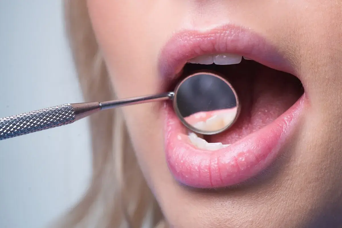 Usta kobiety z otwartymi zębami, w których odbija się lusterko dentystyczne. Widoczny brak szkliwa na zębach.