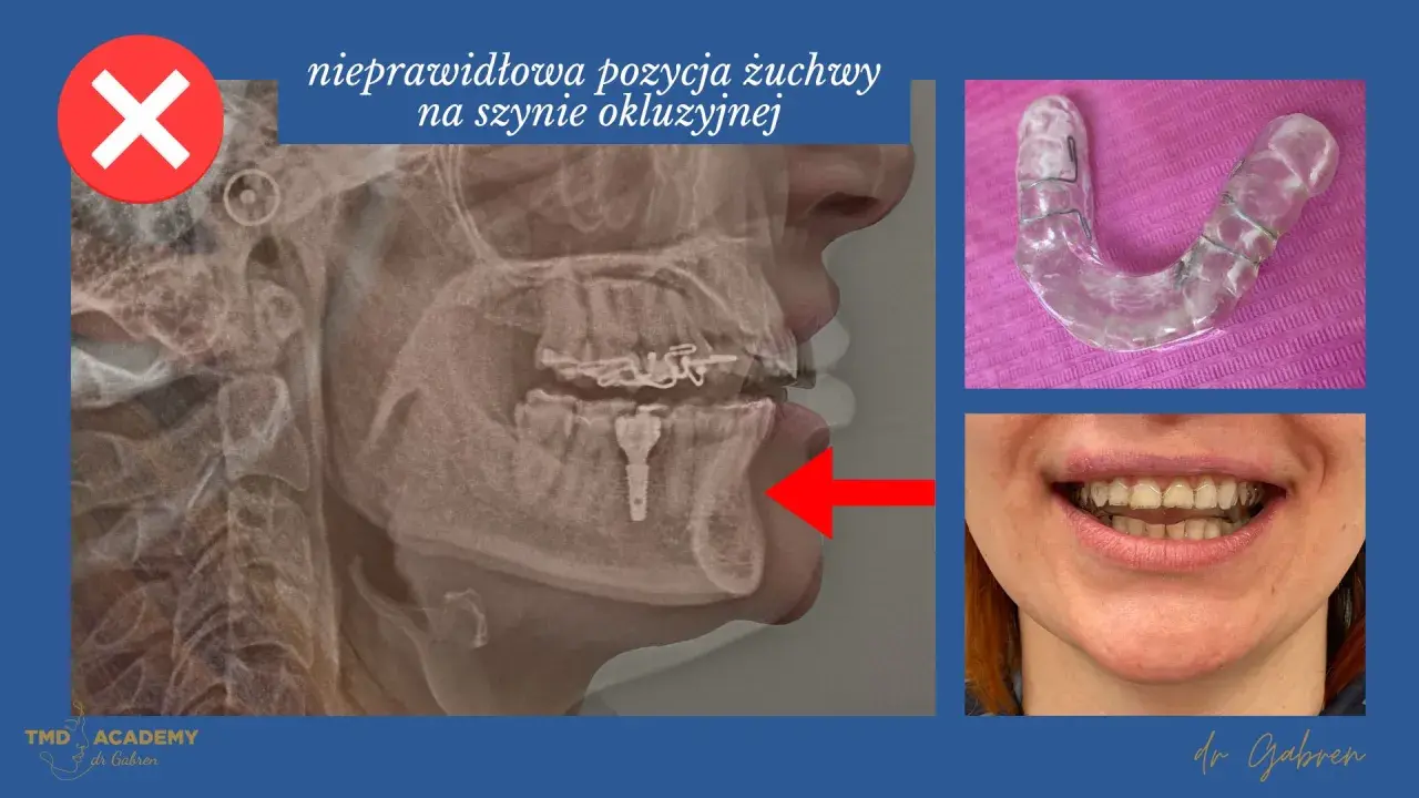Rentgen żuchwy z nieprawidłową pozycją na szynie zgryzowej. Widoczna szyna i uśmiech pacjentki.
