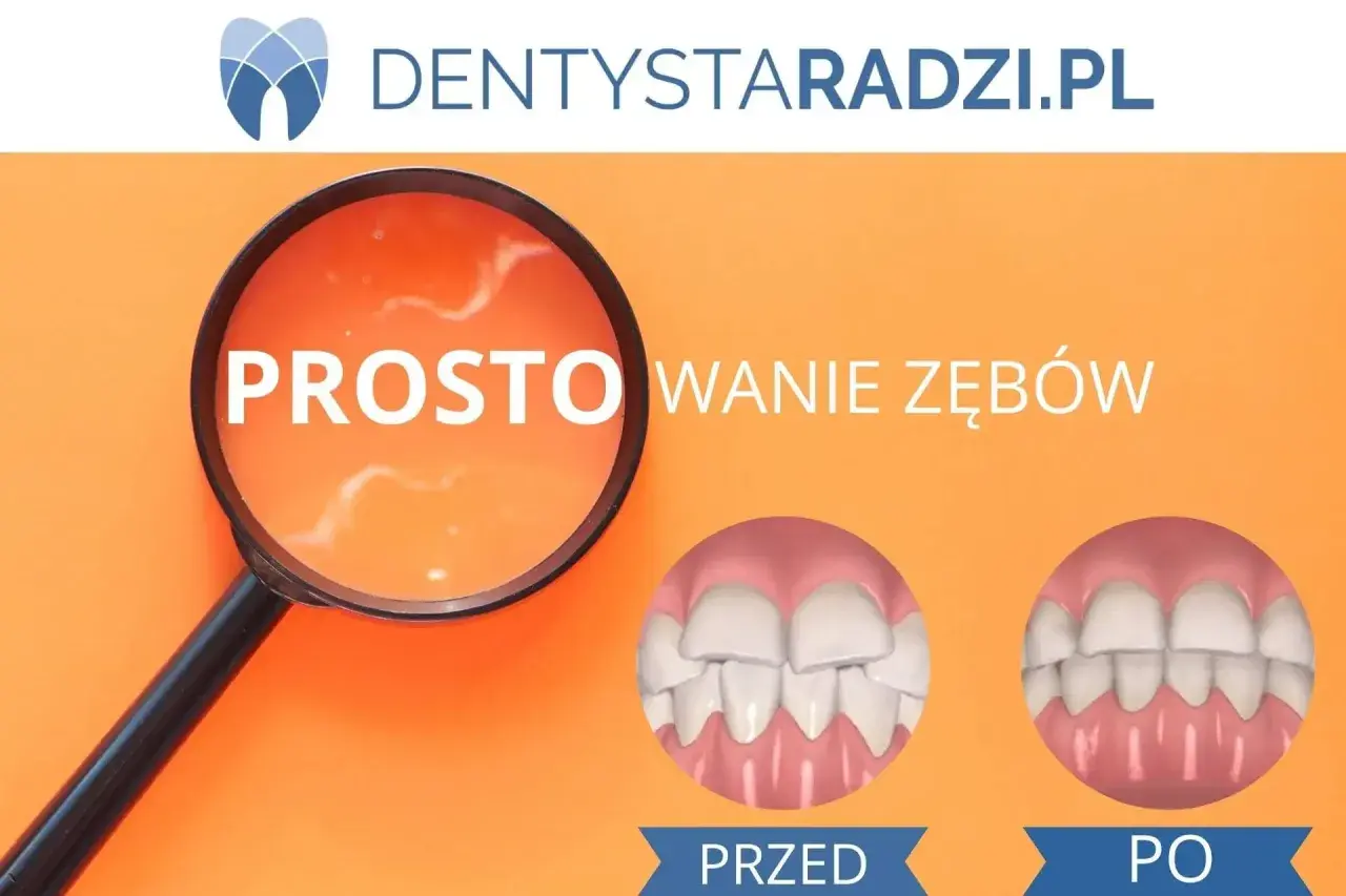 Proste wyrównanie zębów dzięki aparatowi ortodontycznemu. Przed i po leczeniu.