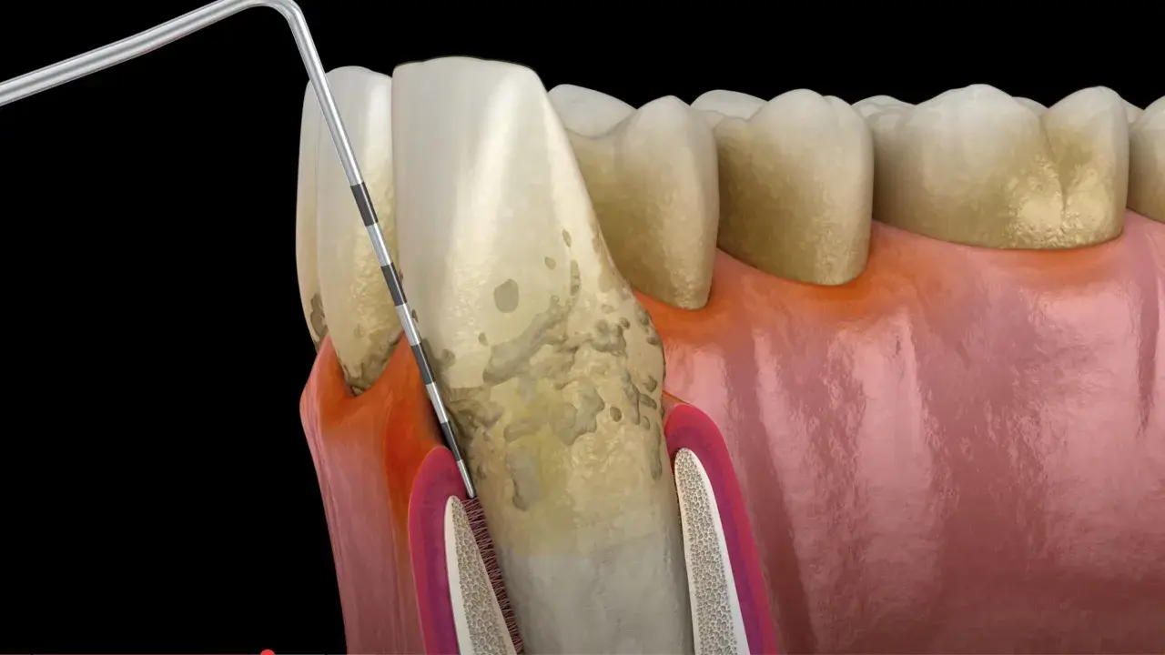 Model zęba z widocznymi oznakami chorób przyzębia. Narzędzie dentystyczne bada kieszonkę dziąsłową, ujawniając problemy, które mogą wskazywać na rzadkie choroby zębów.