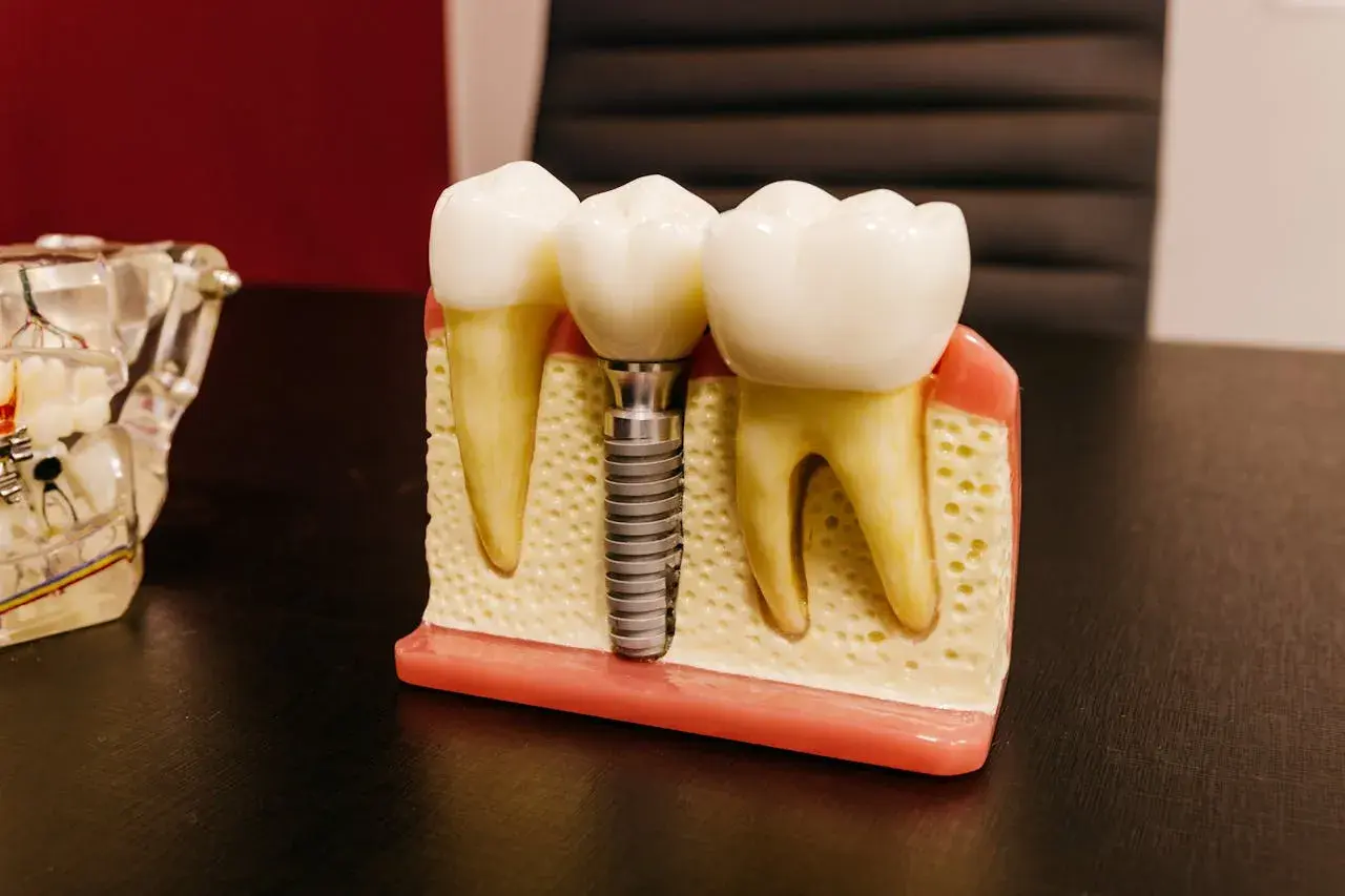 Model szczęki z zębami, gdzie jeden z nich zastąpiono przez mini implant ortodontyczny.