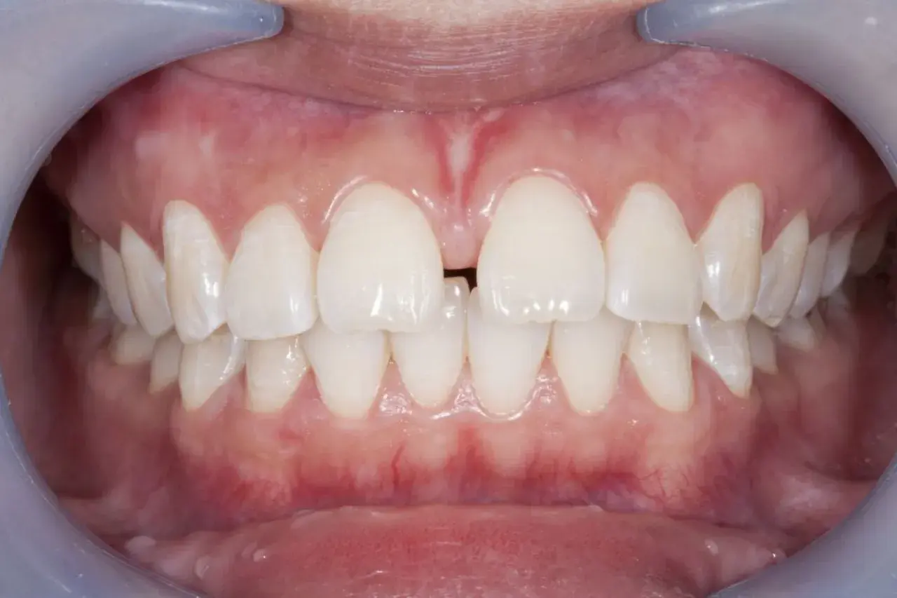 Widoczne zęby z diastemą, czyli przerwą między jedynkami. To pytanie: diastema co to?