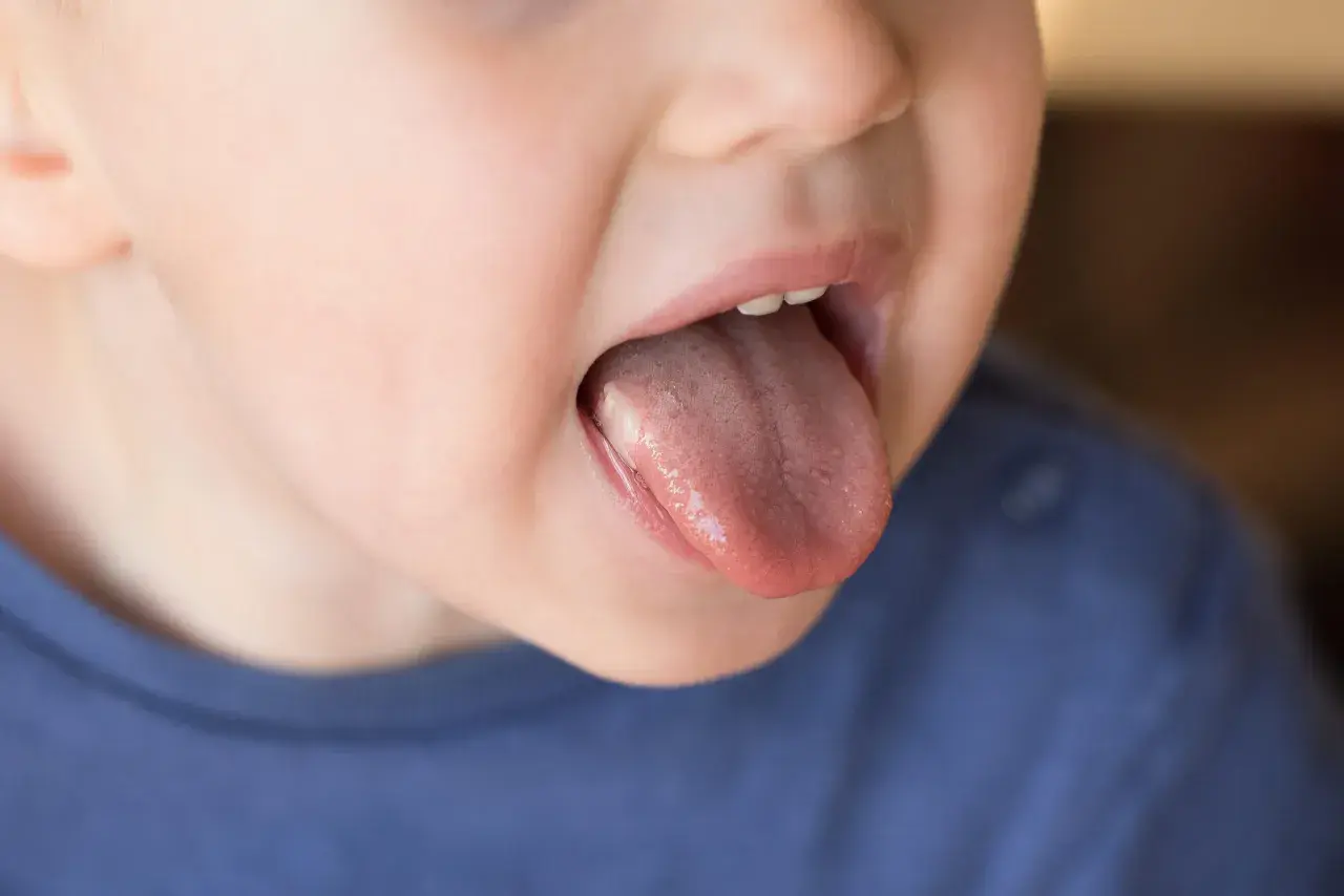 Dziecko pokazuje język z białym nalotem. Szukamy pypeć na języku domowe sposoby.