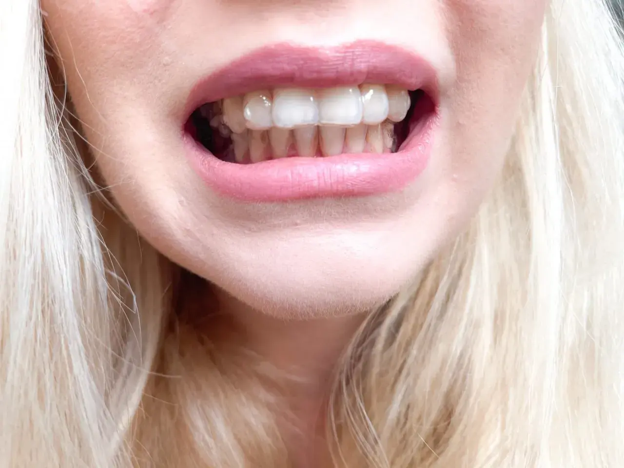 Uśmiech z widocznymi, przezroczystymi nakładkami Invisalign na zębach.