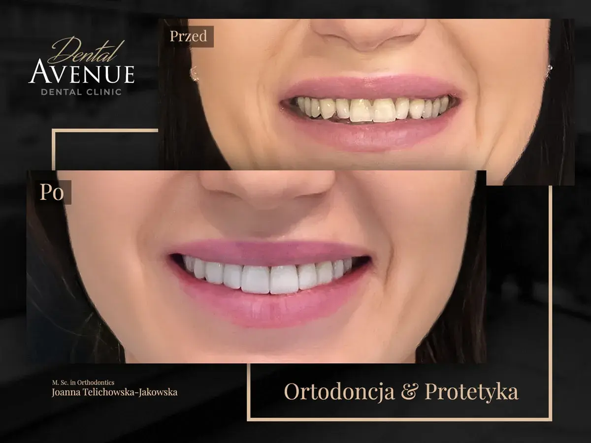 Uśmiech przed i po leczeniu ortodontycznym. Piękne, proste zęby po metamorfozie.