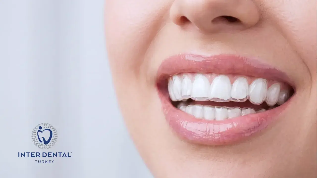 Uśmiechnięta kobieta z dyskretnymi, przezroczystymi nakładkami na zęby. Inter Dental Turkey oferuje estetyczne rozwiązania dla pięknego uśmiechu.