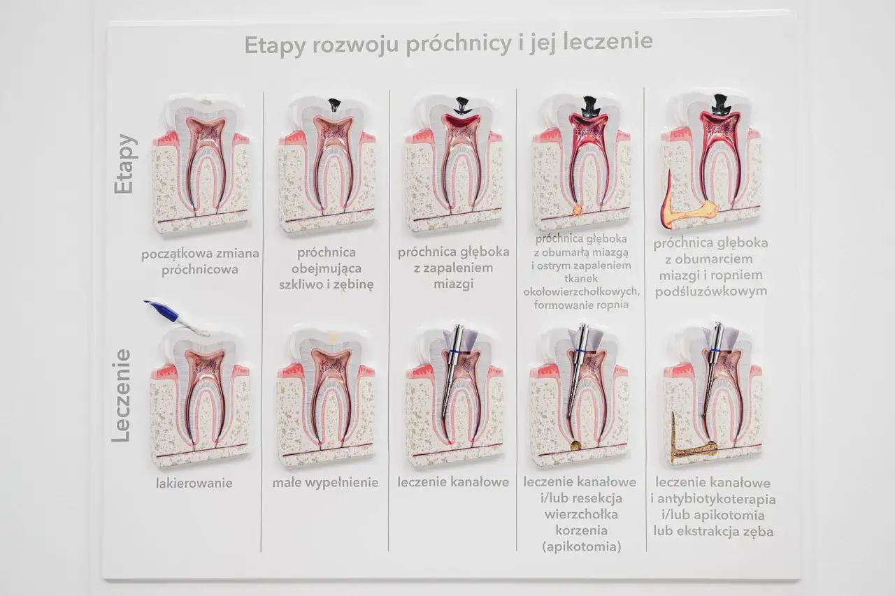 Model przedstawia etapy rozwoju próchnicy, od początkowej zmiany do głębokiego zepsucia z ropniem. Widoczny jest zgniły korzeń zęba, który wymaga leczenia kanałowego lub ekstrakcji.