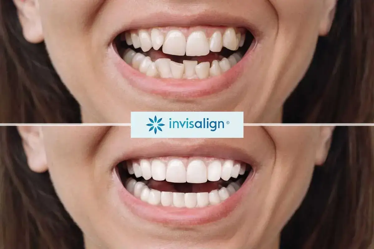 Przed i po: krzywe zęby stały się proste dzięki Invisalign. Dowiedz się, jak wyprostować zęby bez aparatu.